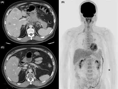 Case Report: Maintenance Nivolumab in Complete Responder After Multimodality Therapy in Metastatic Pancreatic Adenocarcinoma